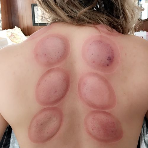 Cupping therapy after suction cups taken off.  No 