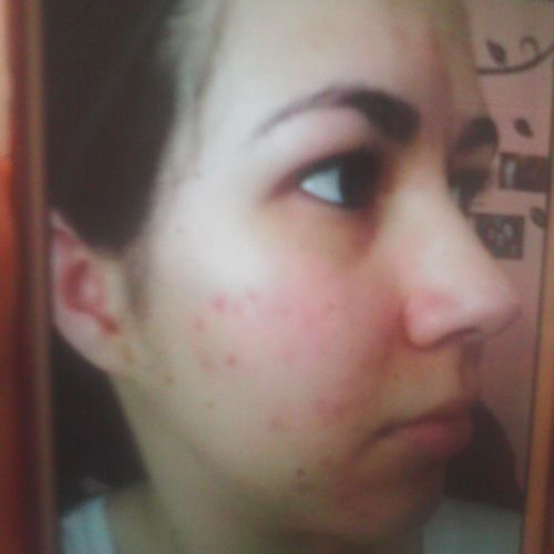 Acne Before treatments