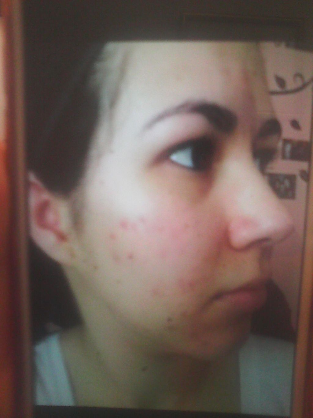 Acne Before treatments