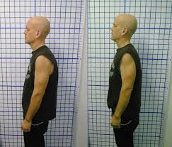 before and after posture treatment