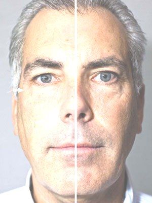 Anti-aging results with a natural non-surgical Fac