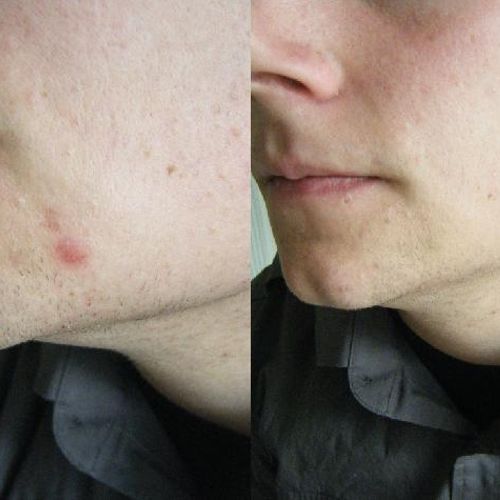 Stress Blemish Before and After