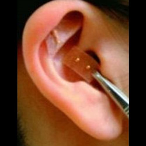 Auricular Therapy also known as: Ear Therapy, Auri