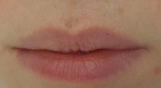 Upper Lip Post Treatment 4