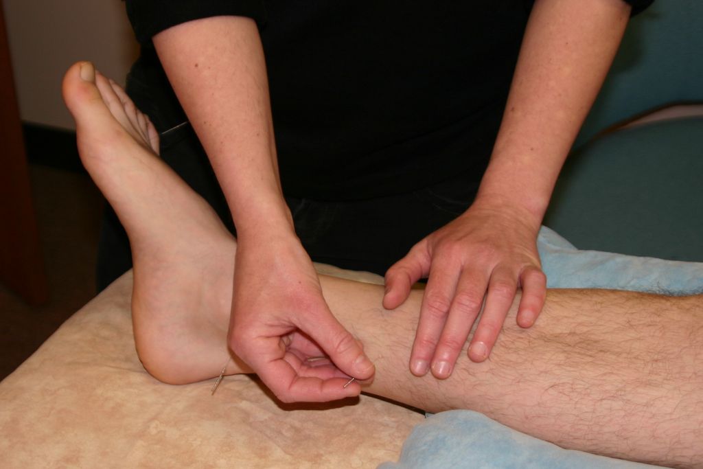 Avigail needling a patient.