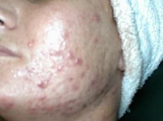 Before picture of acne