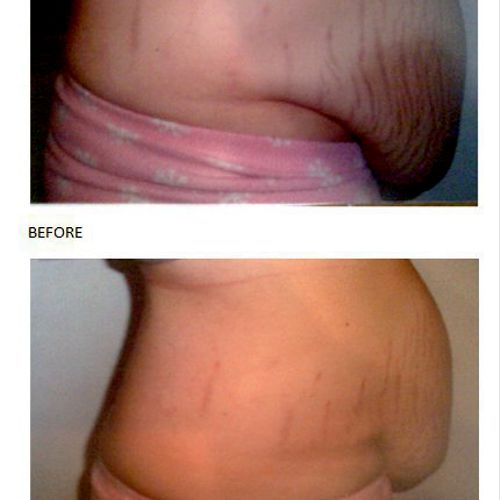 Lose unlimited Inches with just one application!