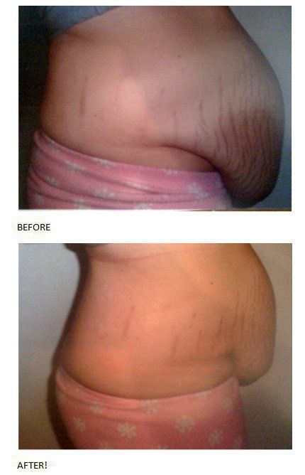Lose unlimited Inches with just one application!