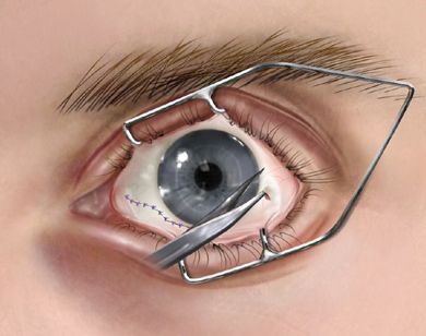 Medical Device / Procedure