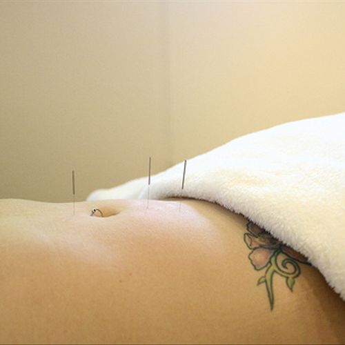 Acupuncture with Amber Scriven