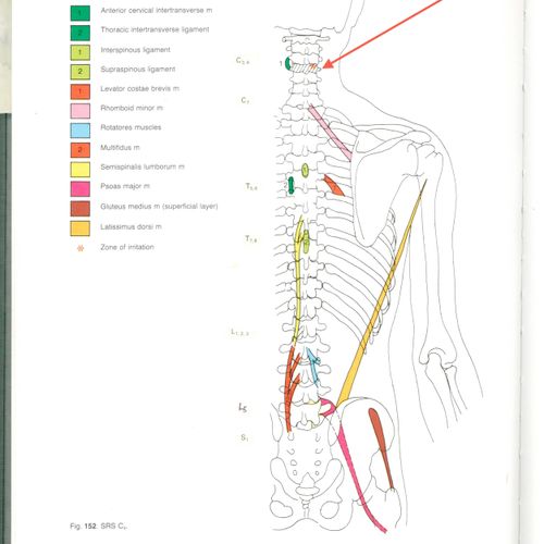 Muscle contractures from a spinal facet joint pain