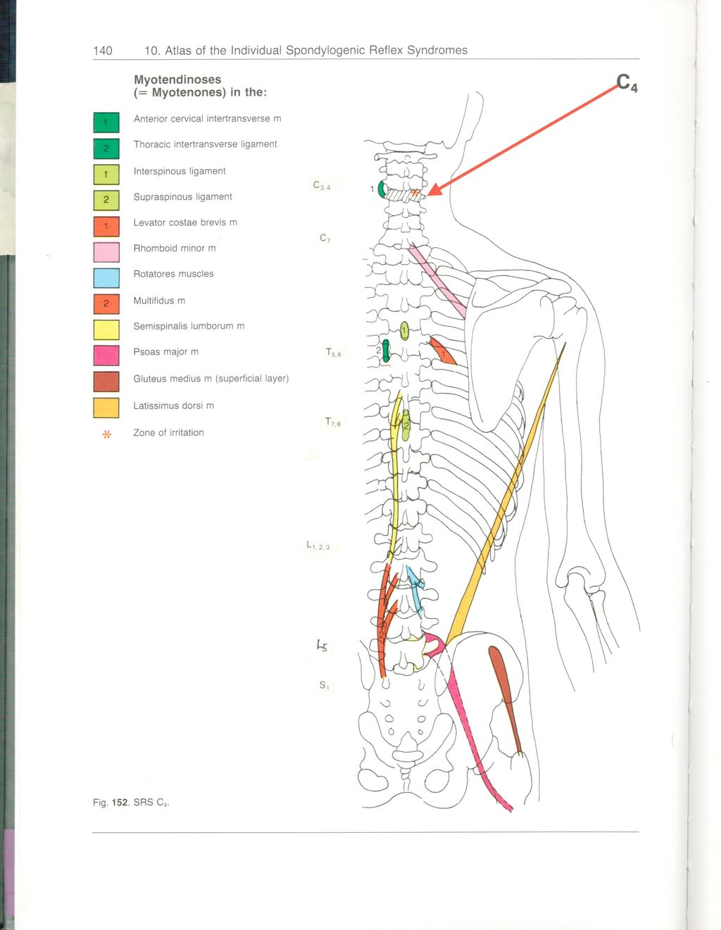 Muscle contractures from a spinal facet joint pain