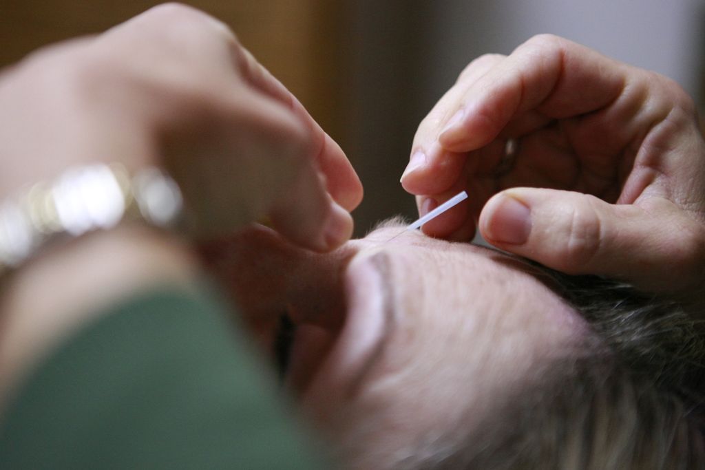 acupuncture