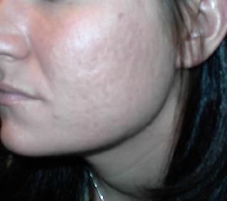 After picture of acne