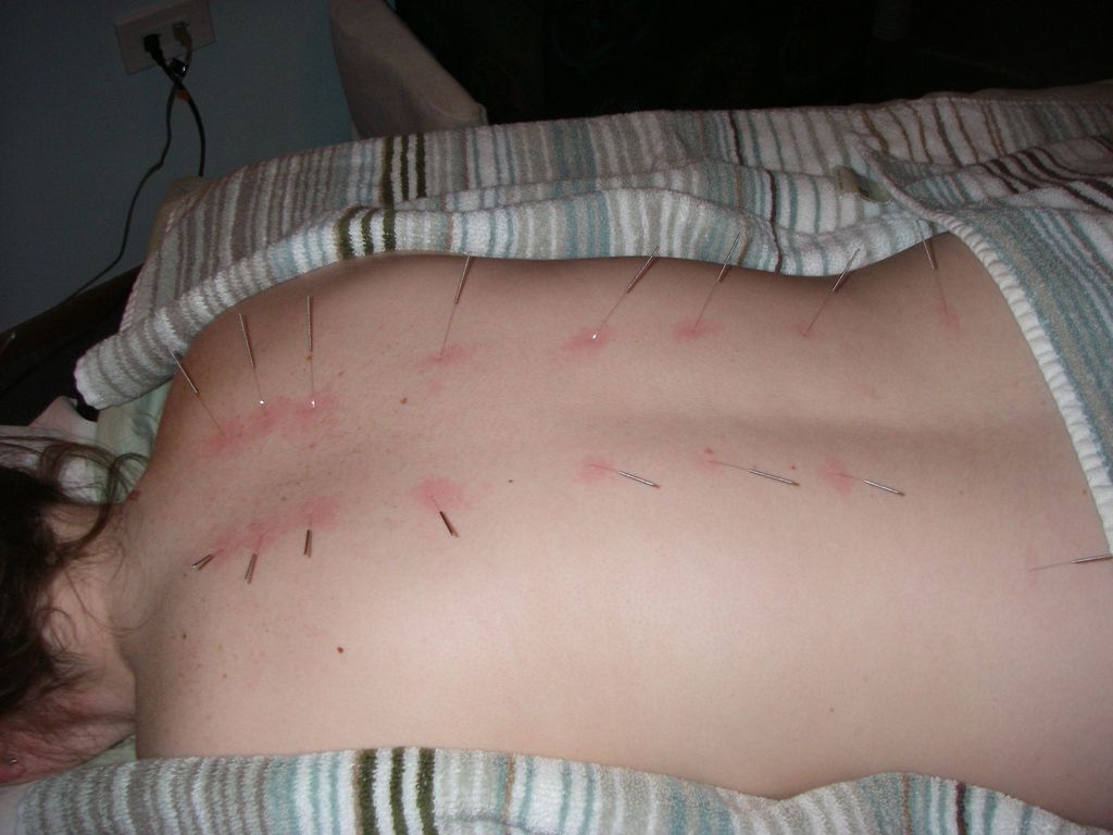 A back clearing treatment.  The red circles around