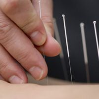 Acupuncture treats over 100 conditions