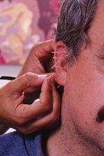 Ear acupuncture: great for stress, appetite contro