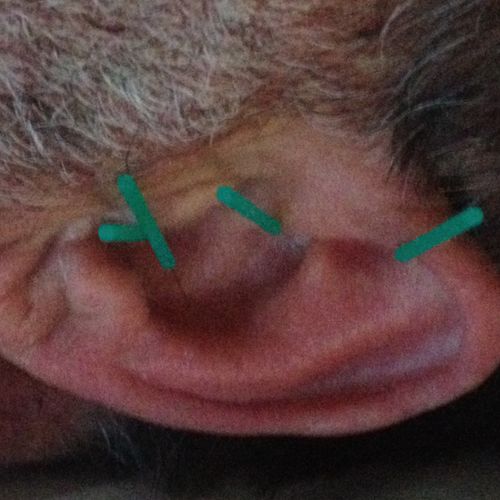 Ear acupuncture can be a powerful adjunct for many