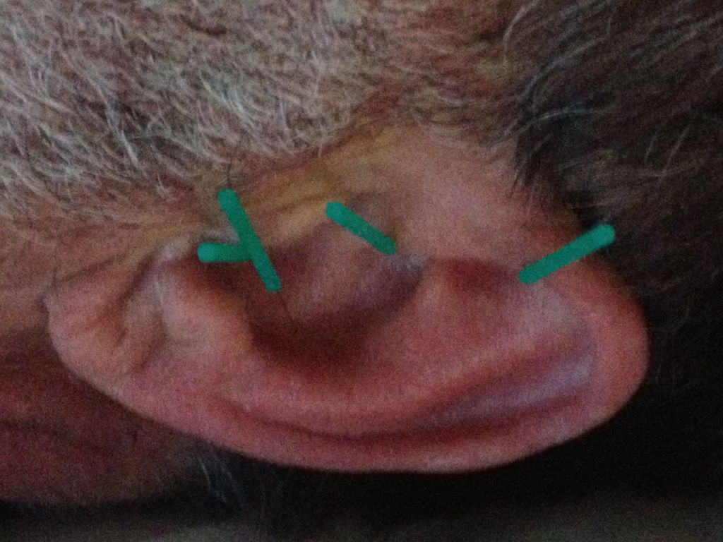 Ear acupuncture can be a powerful adjunct for many