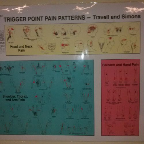 Pt 1 Trigger Point pain pattern by Simon ant Trave