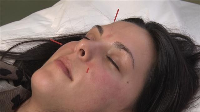 Acupuncture for stress management and relaxation
