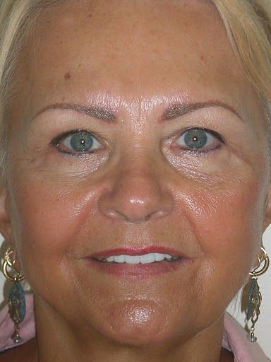 Client was photographed immediately after the eyeb