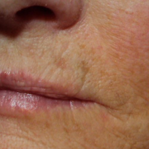 Mouth of client AFTER Regeneration Skin Spa Treatm