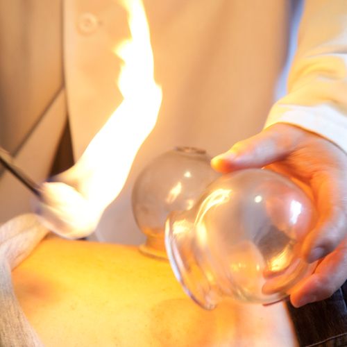 Fire Cupping for muscle pain, increased energy, de