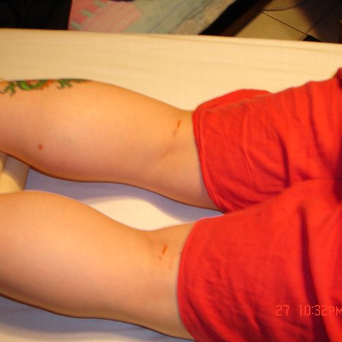 Posterior leg treatment