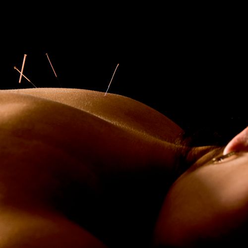 Acupuncture is one of the safest medical treatment