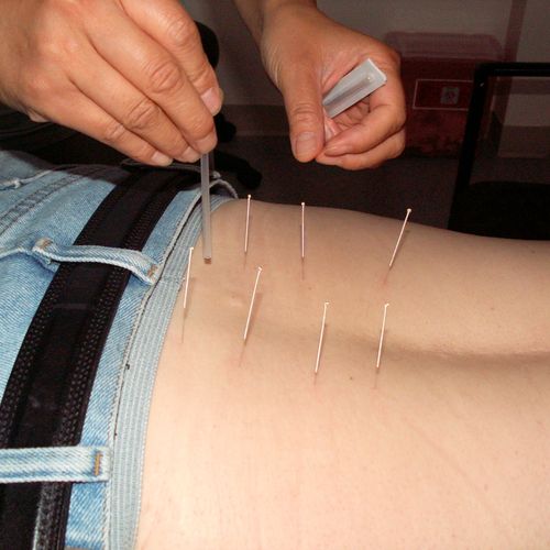 Dr. Wendy Wang is applying needle acupuncture.