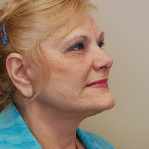 Patient After Natural Lift (Face and Neck Lift)