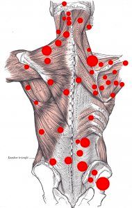 Most common areas for trigger points