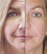 Elastin and Collagen Infusion Therapy for Anti-agi