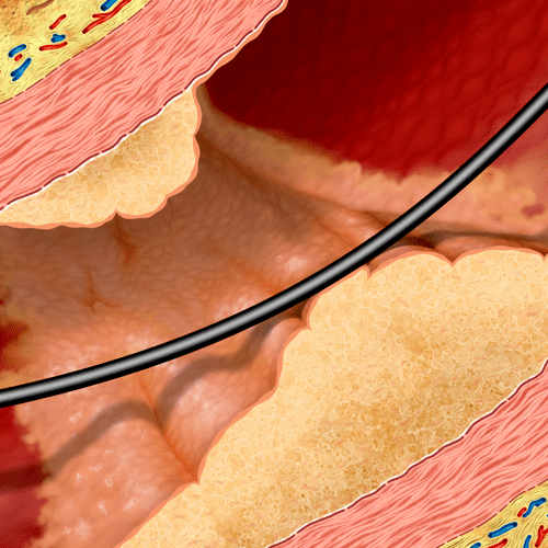 Atheromatous plaque in an artery (longitudinal sec