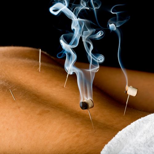 Acupuncture and Moxa Treatment