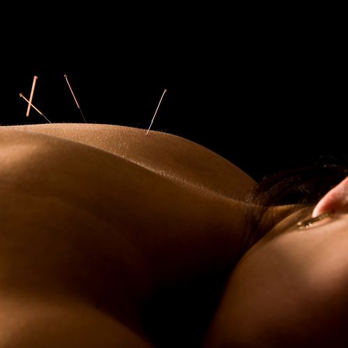 Acupuncture is very relaxing and the needles are v