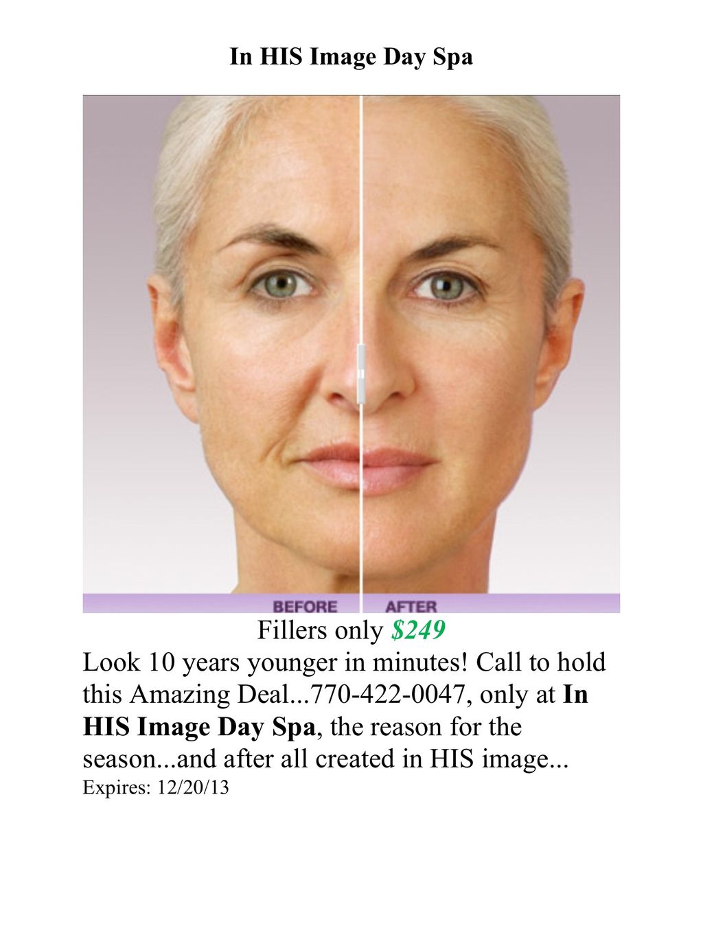 Fillers by Dr. Holland