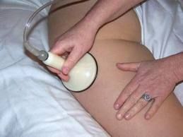 Body Reducing cupping massage