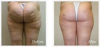 What Body Reducing Cupping Body Wraps can do for y