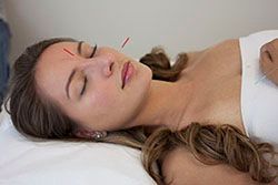 Acupuncture - practice of inserting needles into s