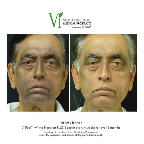 VI Peel on Malasma/Hyprpigmentation