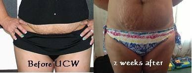 Before & After Universal Contour Wrap