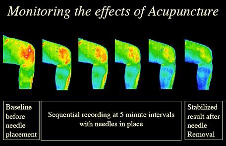 Acupuncture for knee and joint pain