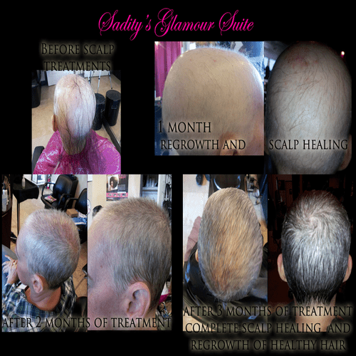 Hair Restoring Scalp Treatments