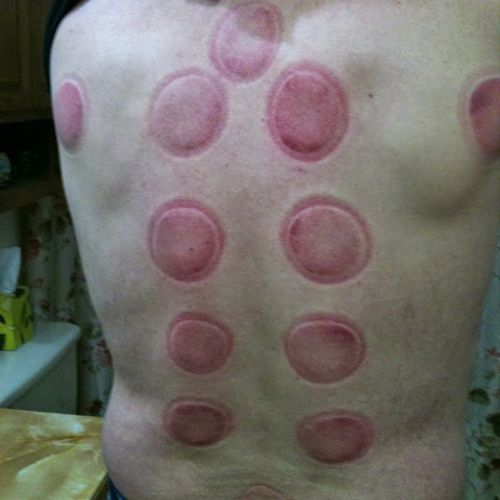 an example of  the results of static cupping. Clie