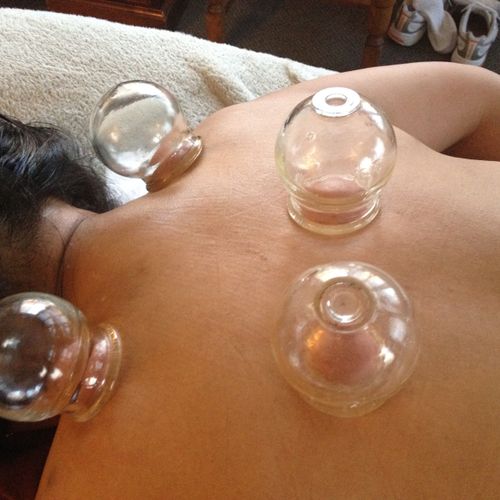 I use many methods of cupping to relieve muscle sp