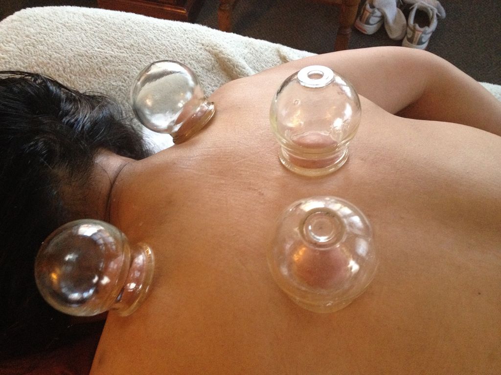 I use many methods of cupping to relieve muscle sp