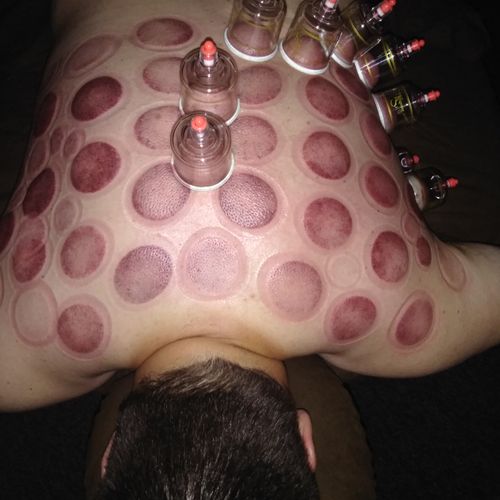 Cupping therapy will draw out toxins in stagnant a