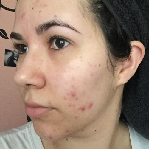 Acne before treatments